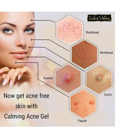 Calming Acne Gel 50ml - Soothing Treatment for Clear Skin | International Shipping - Buy Online on GoSupps.com