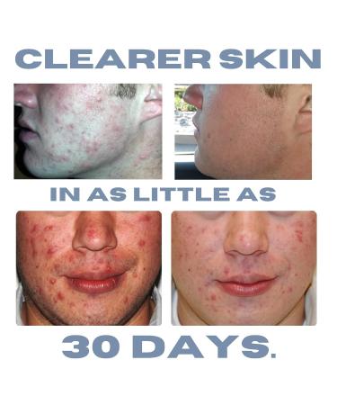 Hormonal Acne Solution | Natural Anti-DHT Benzoyl Peroxide Formula | 1 Month Original Benzoyl Kit - International Shipping - Buy Online on GoSupps.com