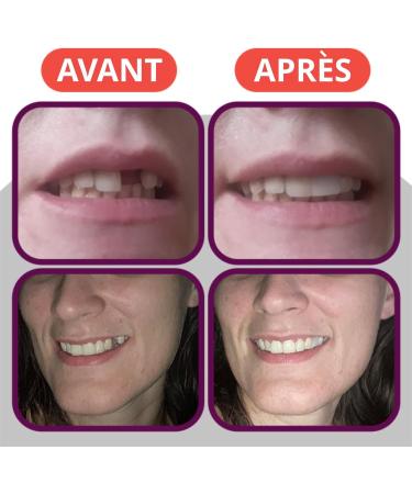 Tout Dentaire REMPLACER une dent manquante P te avec FABRICADENT Vu la t l sur M6 - Buy Online on GoSupps.com