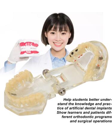 Buy Verdant Touch Transparent Dental Implant Model - Ideal Teaching Aid for Pathology & Dental Studies | International Shipping Available - Buy Online on GoSupps.com