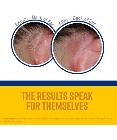 O'Keeffe's Itch Relief Body Cream 48 Hour Itch Relief for Dry and Eczema Prone Skin Fragrance Free Steroid Free Hypoallergenic 8 oz / 227 g Tube (Pack of 1) 105253 White - Buy Online on GoSupps.com