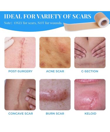 Professional Silicone Scar Sheets Roll - 60 x 1.6 Inches | Reusable Treatment for Keloid, C-Section, Surgery & Acne Scars - Buy Online on GoSupps.com