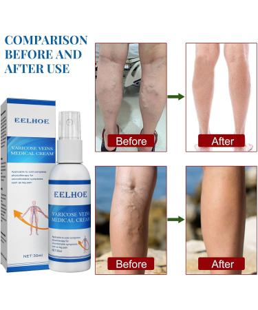 30ml Blood Vein Leg Relief Spray | Promote Circulation & Smooth Veins | Vasculitis Support | Foot Masks & Lipstick Remover | White One Size - Buy Online on GoSupps.com