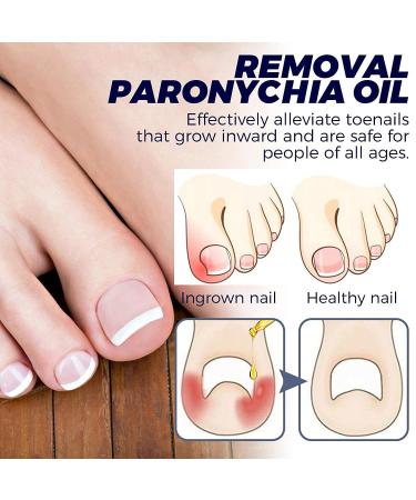 German Toenailcare Removal Paronychia Oil - Nail Renewal Liquid for Damaged Nails - Toenail Treatment Oil for Repair and Improve Toenail Health (2pcs) - Buy Online on GoSupps.com