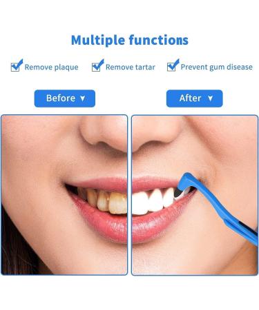Professional Tartar Remover Set | Teeth Cleaning & Stain Removal | Tooth Polisher for Plaque & Discoloration - Buy Online on GoSupps.com