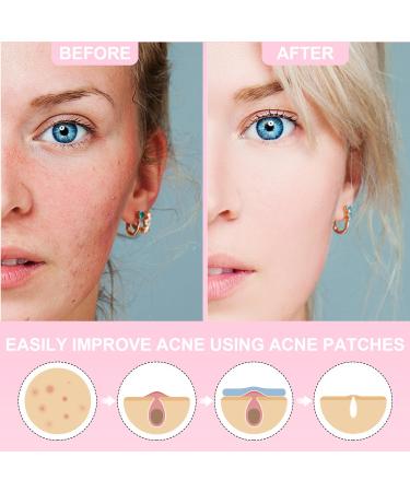 QIAOMU Anti-Acne Patches - 216 Pieces 6 Star Patterns for Facial Blemishes & Acne Marks - Effective Spot Treatment - Buy Online on GoSupps.com
