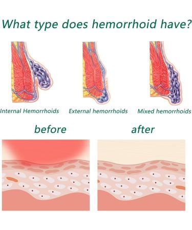 Gelanori Natural Hemorrhoid Cream - 6 * 20g (6 pcs) | Hemorrhoid & Fissure Ointment - Buy Online on GoSupps.com