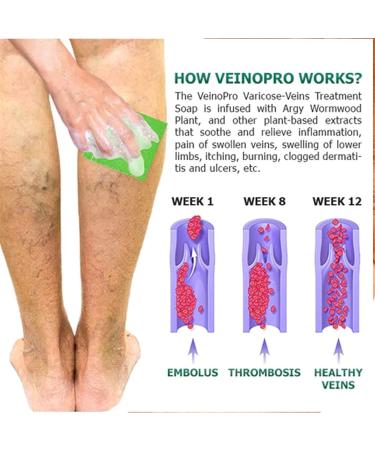 Buy Varicose Vein Treatment Soap - Ginger Infused Wood Soap for Smooth Skin (1 Piece) - International Shipping Available - Buy Online on GoSupps.com