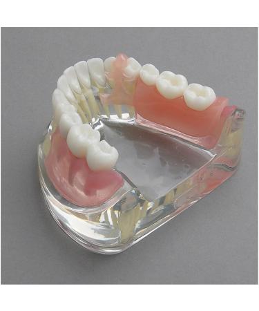 Dental Upper Implantate Model - Superior Overdenture Restoration for Education | Transparent Vision & Soft Gum - Ideal Study Tool - Buy Online on GoSupps.com