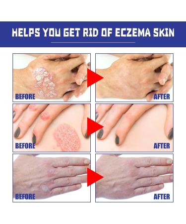 EXQST 30ml Psoriasis Repair Spray - Herbal Treatment for Skin Plaque Psoriasis - Stops Burning and Itching - 3pcs - Buy Online on GoSupps.com