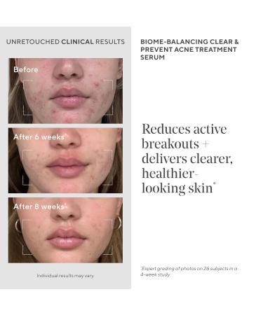 Murad Biome-Balancing Acne Treatment Salicylic Mandelic and Glutamic Acid Serum for Clearing and Preventing Breakouts Decongesting Pores and Balancing Skin Microbiome 1.0 Fl Oz - Buy Online on GoSupps.com