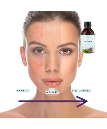 Inositol Fem Acnesitol 3000mg - Hormonal Acne Solution Female Balance | 14-in-1 Formula with Myo & D-Chiro Inositol NAC Niacin Vitamin A Selenium Zinc Chromium & BioPerine - Buy Online on GoSupps.com