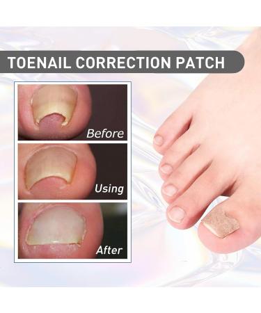 MFCGHXR Nail Care Toenail Correction Patch Set of 124 Includes Patch Nail Stickers File Lifter & Remover Black L - Buy Online on GoSupps.com