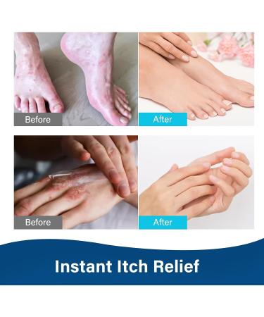 iTecFreely Athletes Foot Spray - Natural Treatment for Fast Relief from Itchy and Inflamed Feet - Buy Online on GoSupps.com