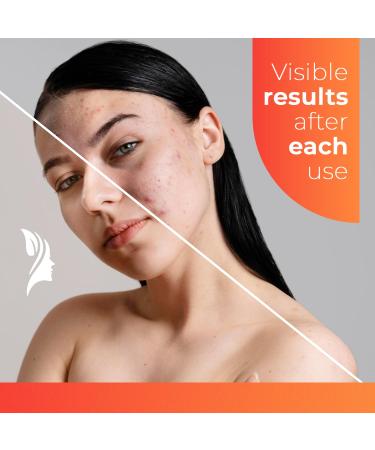 Hydrocolloid Acne Patches for Face - Best Spot Treatment for Breakouts | Blemish & Pimple Relief | Fast Shipping Worldwide - Buy Online on GoSupps.com