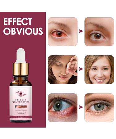 Stye Eye Treatment Chalazion Remover - Fast Relief Serum for Eye Irritation and Eyelid Relief - Buy Online on GoSupps.com