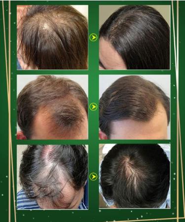  Huien Huien Hair Growth Serum for Men and Women 120 ml Hair Regrowth Lotion and Hair Growth Care DHT Blocker - Buy Online on GoSupps.com