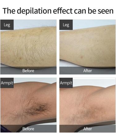 3-in-1 IPL Laser Hair Removal Device - Painless Fast & Effective for Men and Women | Home Use Full Body Elitzia Etippl3 - Buy Online on GoSupps.com