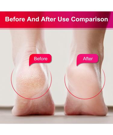 Jasmine Callus Remover Gel 8.4 oz with Pumice Stone Scrubber Kit - Professional Pedicure, Remove Hard Skin, Heels Calluses - 12 Pack - Buy Online on GoSupps.com