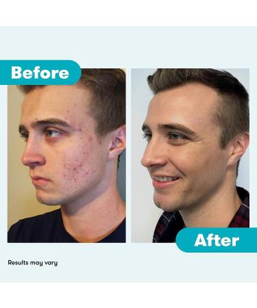 Proactiv 3 Step Acne Treatment Kit with Benzoyl Peroxide Face Wash, Repairing Spot Treatment, and Exfoliating Toner - 30 Day Complete Skin Care Solution - Buy Online on GoSupps.com