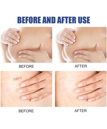 4 Pairs Breast Scar Sheets for Surgery Scar Repair - Fade, Flatten, and Remove Surgical Scars - Buy Online on GoSupps.com