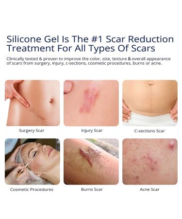 SIL Solutions 1x18 C-Section Abdominoplasty Silicone Sheeting - Medical Grade Scar Treatment - Buy Online on GoSupps.com