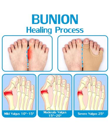 Bunion Pads - Upgraded Relief Protector Guards for Thumb & Little Toe | Breathable Day & Night Support for Hallux Valgus Pain | Two Sizes Fit Most - Buy Online on GoSupps.com