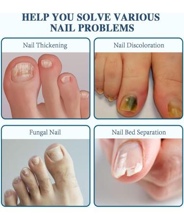 iKeener Nail Fungus Light Treatment Device For Toenail Toe Nail Fungus Treatment Extra Strength With 407nm Blue Light&905nm Light For Nail Fungus& Onychomycosis Fingernail Fungus Removal At Home HZJ-01 - Buy Online on GoSupps.com