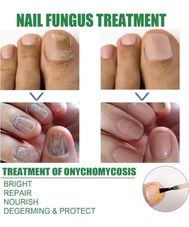 Fungal Nail Treatment For Toenails - Extra Strong Nail Fungus Treatment For Anti Fungal Nail Treatment - Fungal Nail Polish For Fix & Renew Damaged Broken Nails - Buy Online on GoSupps.com