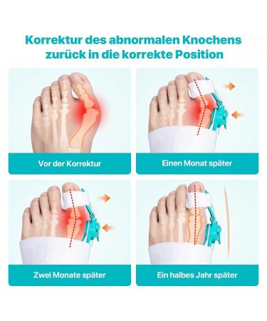 Moicainy Hallux Valgus Correction Kit - Toe Spreader Silicone Bands & Training Device for Bunion Relief | International Shipping - Buy Online on GoSupps.com
