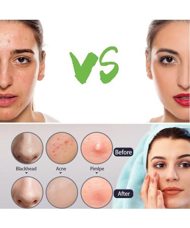 2023 Blackhead & Pimple Extractor Kit - Acne Removal & Blemish Treatment Tools - Buy Online on GoSupps.com