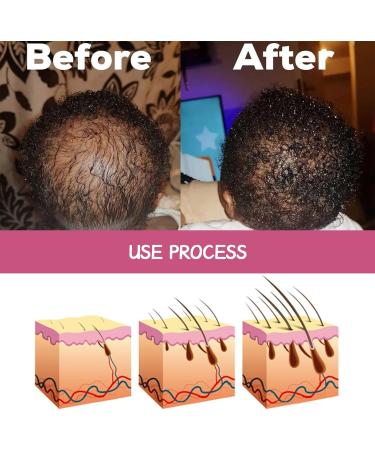 Les Huiles De Batana Pour La Croissance Des Cheveux REGROWTH Traitements Repousse Renforcent Le Cuir Chevelu Am liorer Circulations Sanguines Du Beurre D'huile Batana Pour La Croissance - Buy Online on GoSupps.com