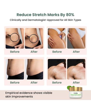 Healoofy Naturals Stretch Mark Cream Powered with bio actives | For Pregnancy | Scar removal and Moisturizing Cream Stretch Mark removal for Stomach thighs & all body parts (200G Pack of 2) - Buy Online on GoSupps.com
