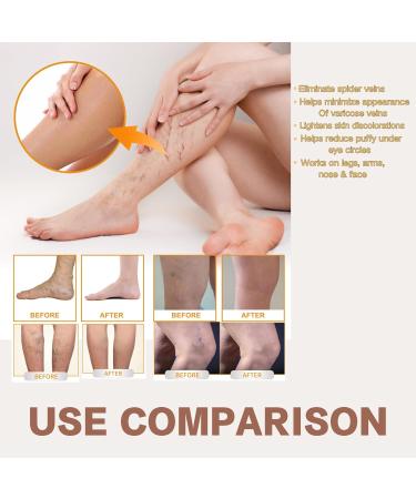 2PCS Varicose Veins Miracle Cream - Vitamin K Cream for Legs & Face Nourishing & Moisturizing for All Skin Types - Buy Online on GoSupps.com