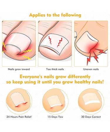 Xinzan 2 Types Ingrown Toenail Treatment Patch with Ingrown Toenail Tool Professional Ingrown Toenail Corrector Tools for Toenail Care Protect Toe Nail - Buy Online on GoSupps.com