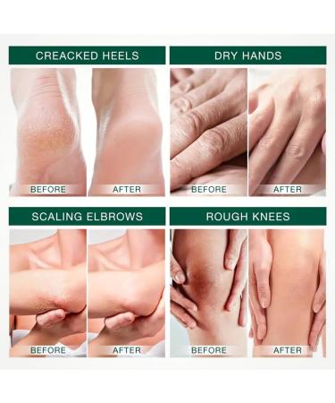 Urea 40% Foot Cream with Tea Tree Oil - Cracked Heel Repair & Deep Moisturizing for Dry Skin - Buy Online on GoSupps.com