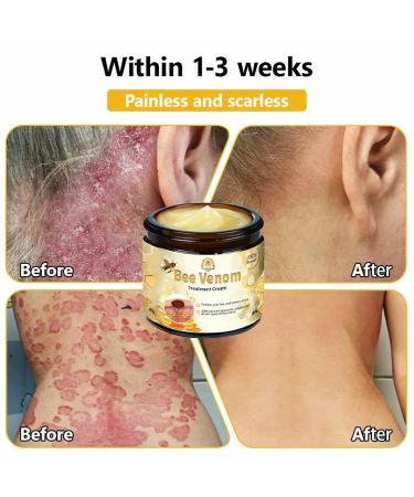 Bee Venom Skin Treatment Cream Bee Venom Cream Effectively reduces all types of skin blemishes(1PC) - Buy Online on GoSupps.com