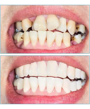 Wfle Instant Veneers - 2 Pair Dental Silicone Prostheses for Teeth Whitening & Temporary Dentures for Men & Women - Buy Online on GoSupps.com