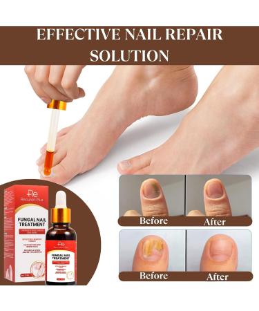 Fungal Nail Treatment for Toenails - Extra Strong 30ml Formula - Safely Reclaim Healthy Nails - Buy Online on GoSupps.com