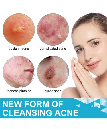 Jonov Acne Pimple Patch - Fast Acting Hydrocolloid Pimple Patches for Night - 18 Blemish Cover Stickers for Face - Buy Online on GoSupps.com