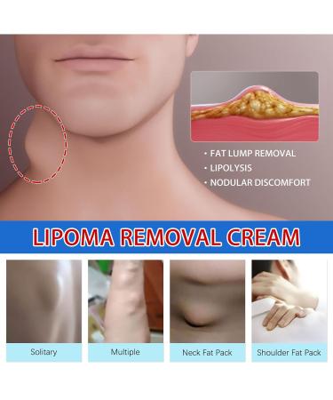 LumpFree Lipoma Removal Ointment for Smooth Skin - G9skin (White, One Size) - Buy Online on GoSupps.com