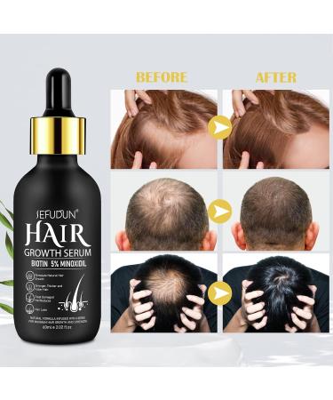 Minoxidil Hair Growth Serum for Men & Women - 5% Minoxidil with Biotin for Thinning Hair - Promotes Thicker Longer Fuller Hair - 2.02 oz - Buy Online on GoSupps.com