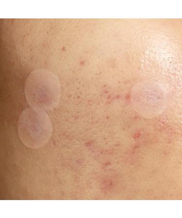 Julep Patch Me Up Waterproof Pimple Patches - 72 Hydrocolloid Acne Patches with Tea Tree Oil for Day & Night - Reduce Blemishes & Scarring - Invisible 8mm & 12mm Options - Buy Online on GoSupps.com