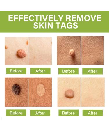 SCOBUTY Skin Tag Removal Kit Verruca Treatment Wart and Mole Remover for Hands Face - Buy Online on GoSupps.com