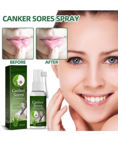 Ulcer Relief Herbal Mouth Spray 20ml - Antiviral Treatment for Canker Sores, Bad Breath, and Dry Mouth - Buy Online on GoSupps.com