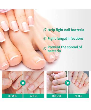 Kerassentials Toenail Fungus Treatment - Healthy Skin, Hair & Nails - 2PC Pack of 1 Fl Oz - Buy Online on GoSupps.com