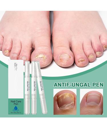 Damaged Nails Pen Strengthening Nourishing Manicure Care Supplies Nail Health Pen for damage yellow discolored thick ingrown fingernails - Buy Online on GoSupps.com