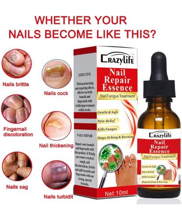 Fungal Nail Treatment - Nail Fungus Treatment for Toenail - Extra Strong Nail Fungus Treatment for Toenail - Anti fungus Nail Repair and Strengthen Fix & Renew Damaged Broken Nails - Buy Online on GoSupps.com