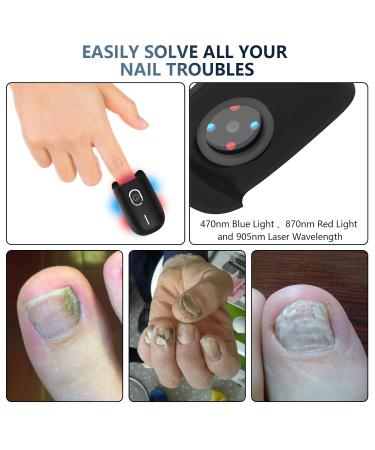 Ikeen Nail Fungus Treatment Device - Effective Onychomycosis Relief with Red & Blue Light Painless & Fast Fuzspilz Solution for Healthy Nails - Buy Online on GoSupps.com