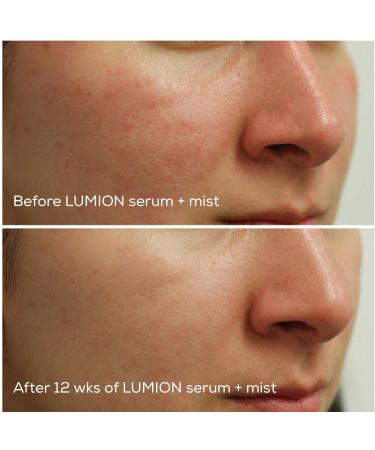 Natural Clear Complexion Face Serum - Soothes Redness & Irritation | Promotes Healthy Calm Skin with Hypochlorous Acid (3.4 fl oz) | International Shipping Available - Buy Online on GoSupps.com